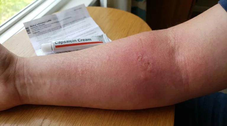 辣椒素外用药会产生哪些皮肤病副作用?风险与管理技巧